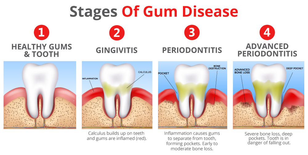 Learn About Gum Disease Gum Infection Stages Periodontitis Treatment 6205